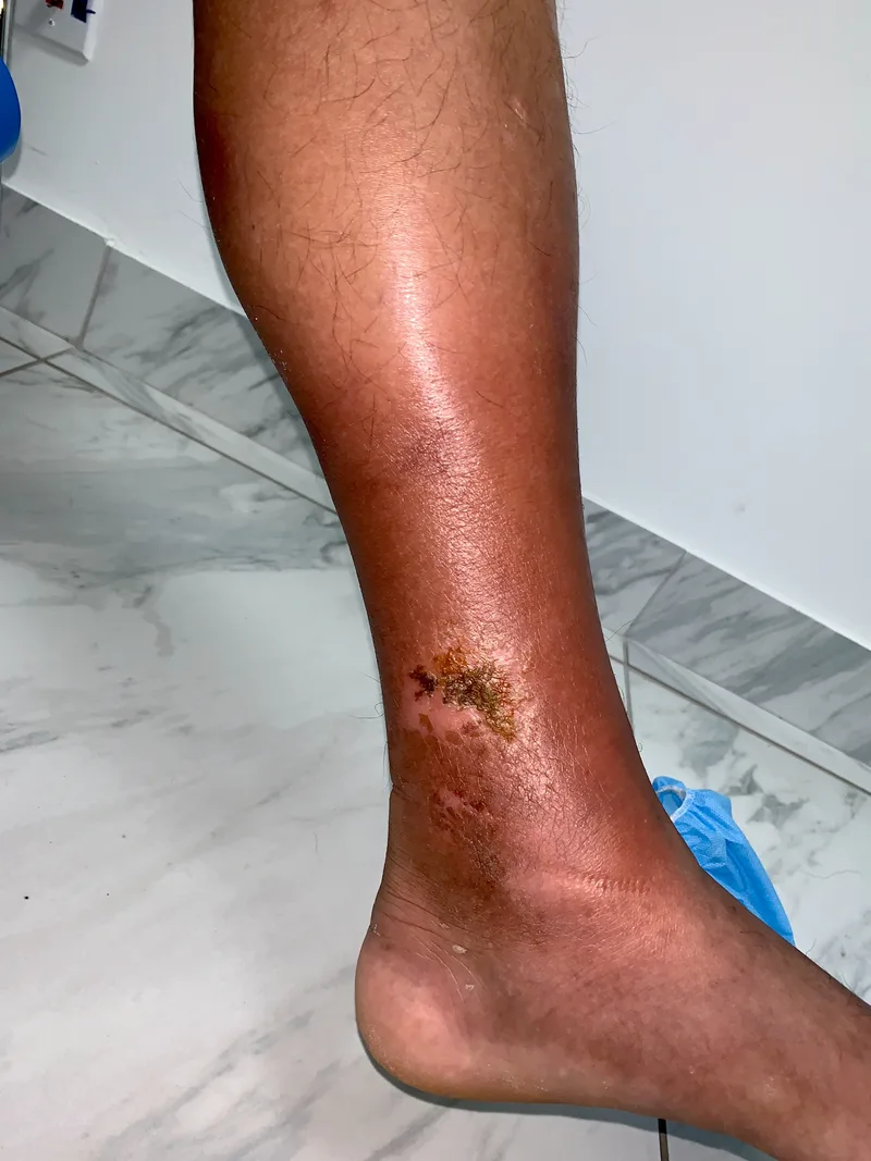 Clinical visual progression of chronic venous disease, demonstrating Stage C1 spider veins, reticular vessels, and Stage C2 tortuous bulging varicose veins. With progress hemosiderin staining. 