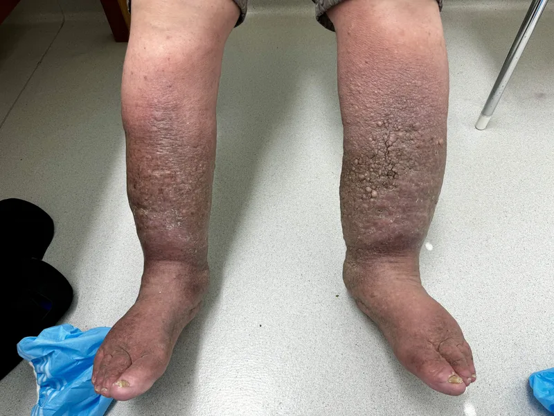 Bilateral clinical photograph of a patient's lower legs and feet demonstrating advanced, chronic phlebolymphedema (Stage 3 elephantiasis) secondary to long-standing venous disease. Both limbs show massive, asymmetric volumetric expansion, profound rust-brown hyperpigmentation from hemosiderin staining, skin thickening, and extensive cobblestone-textured fibrotic papules across the shin and ankle zones. The left lower extremity features deep skin fissures and dense epidermal thickening, capturing total anatomical contour loss and irreversible microvascular fluid transport failure.