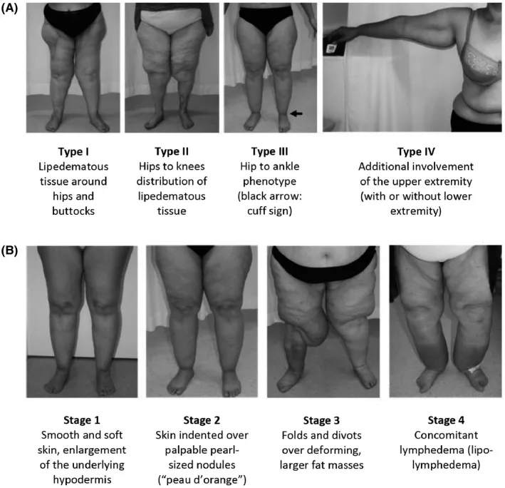 Black and white clinical photographic compilation charting the anatomical classification of Lipedema across two distinct rows. Row A illustrates the distribution pools across Types I, II, III (demonstrating the definitive ankle cuff sign), and IV (demonstrating bilateral upper extremity involvement). Row B profiles the progressive pathological stages from Stage 1 smooth subcutaneous enlargement, Stage 2 dimpled peau d’orange nodularity, Stage 3 massive deforming fibrotic fat lobes, up to Stage 4 systemic lipo-lymphedema.