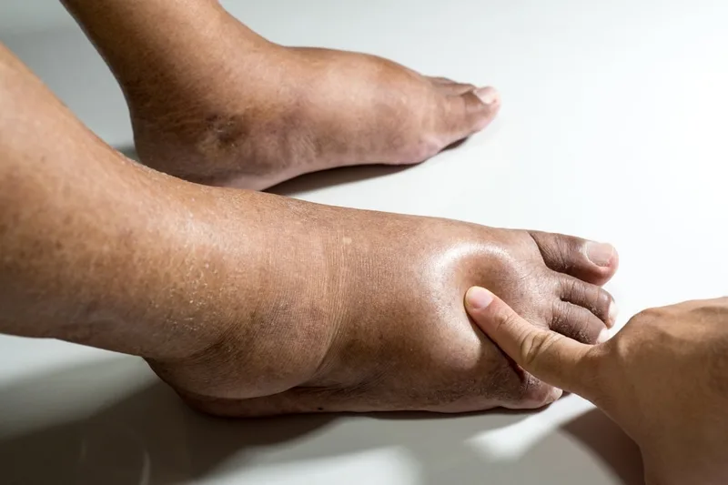 Close-up clinical photograph demonstrating a manual bedside evaluation for severe pitting edema on a highly swollen lower extremity. A clinician’s finger presses firmly into the puffy skin on the dorsum of the foot, creating a clear, temporary indentation or 